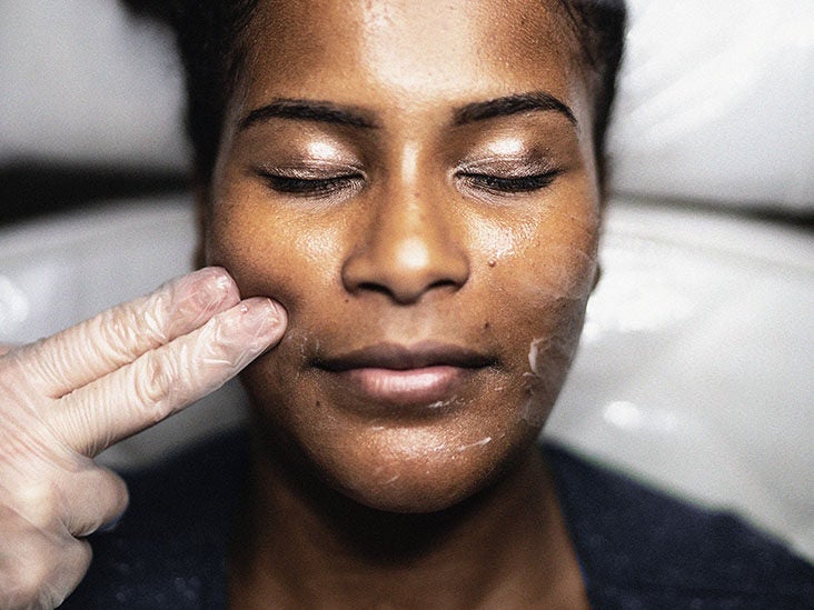 chemical peels before and after women of color