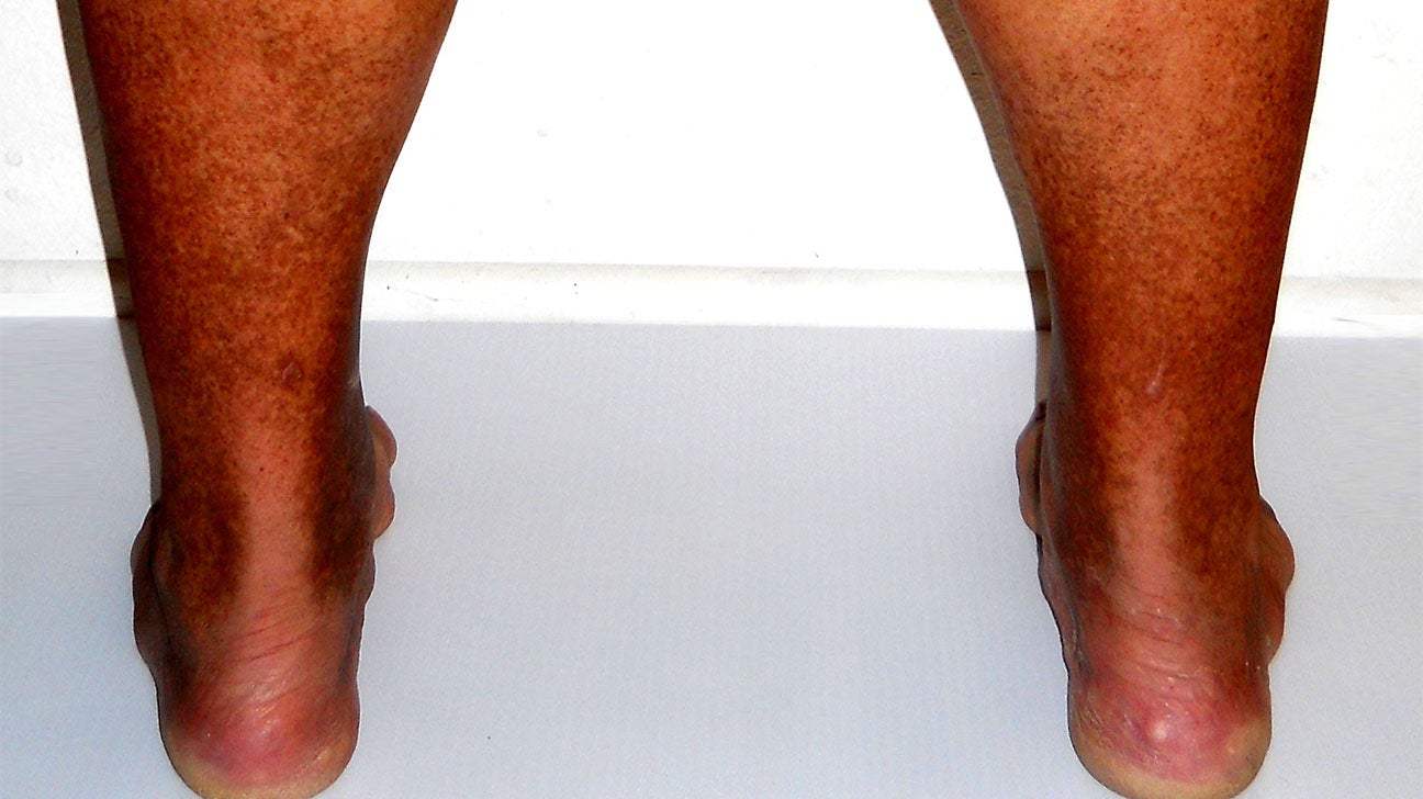 Swollen legs and ankles: Causes and their treatments