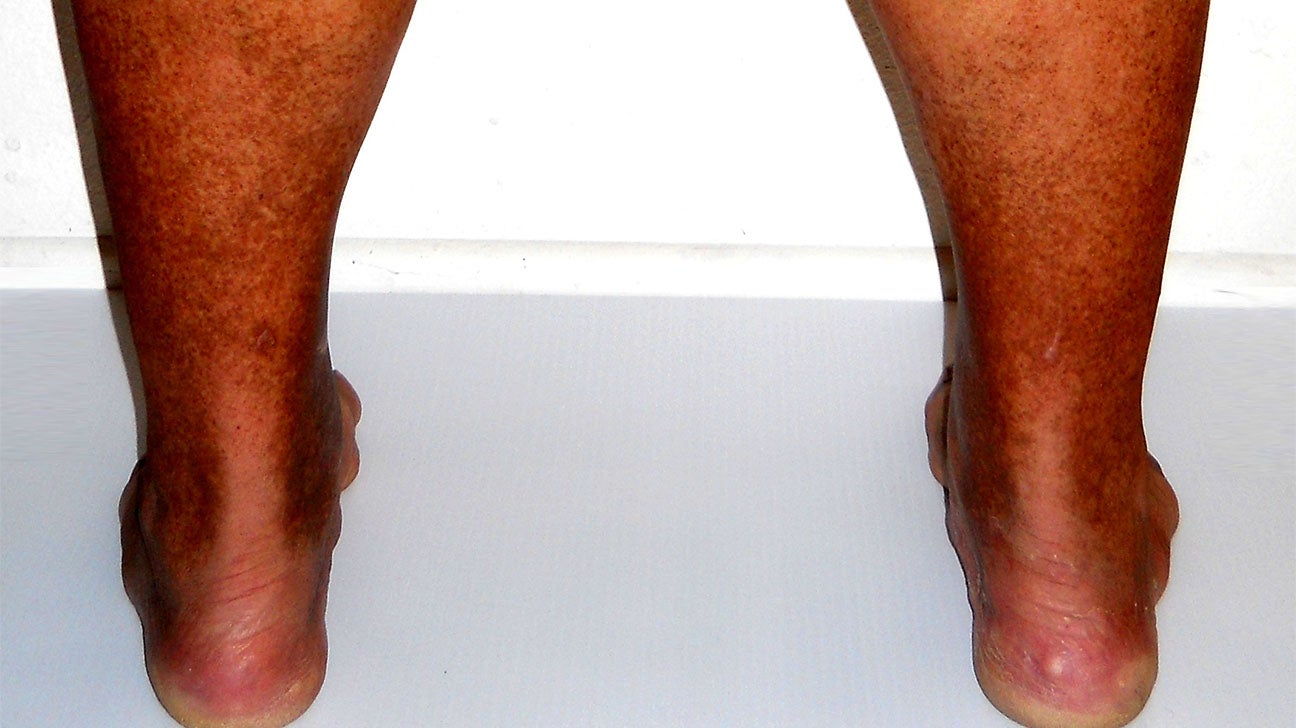 Why One Foot, Ankle, or Leg Might Be Swollen