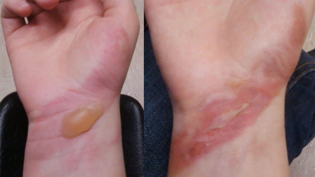 Firstdegree burn Treatment, symptoms, and pictures