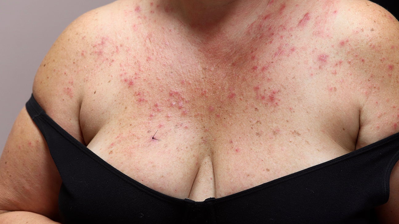 Non-itchy Rash between breasts (pic) - October 2015 Babies