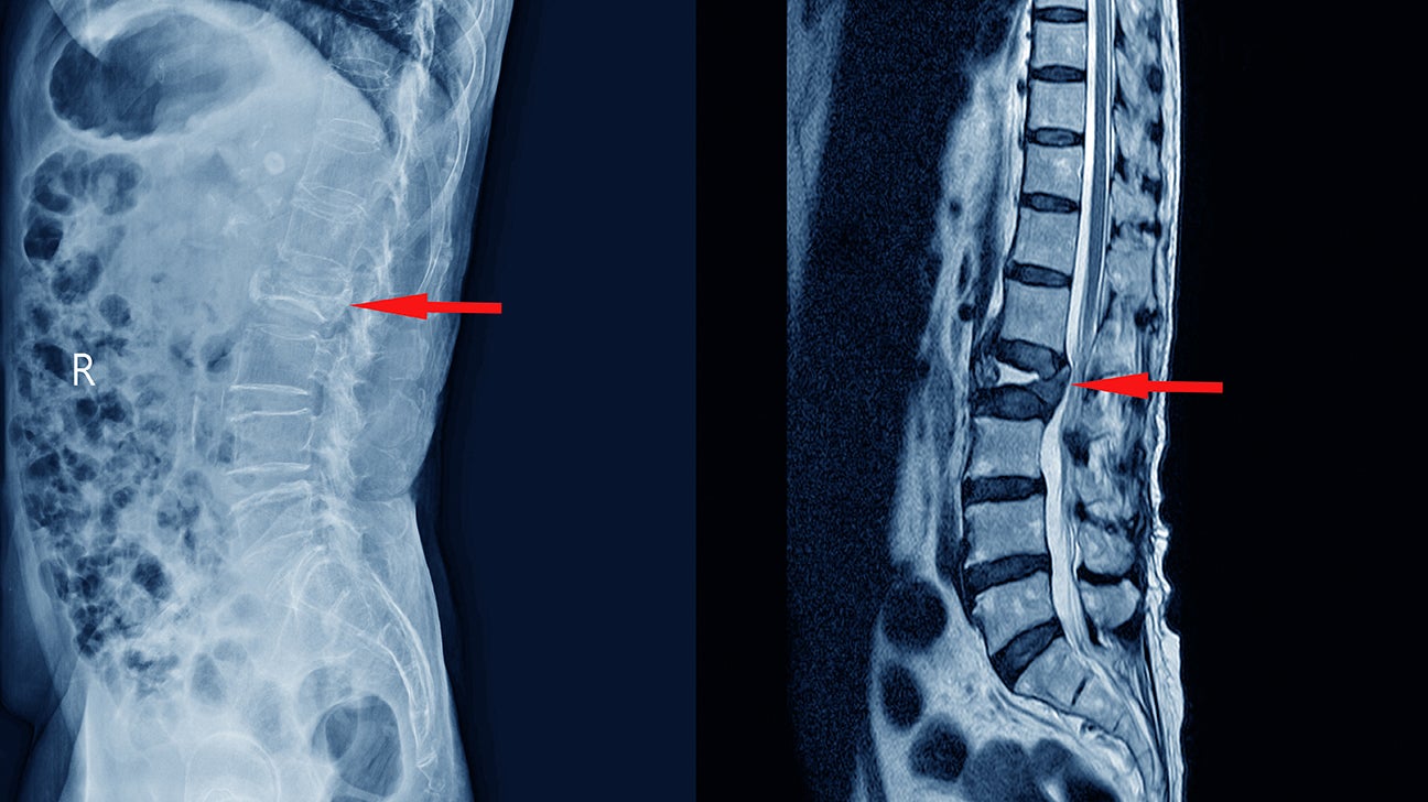 Common Bulging Disc Symptoms In Your Lower Back