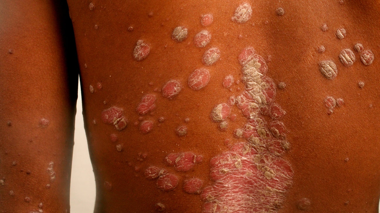 maculopapular rash hiv