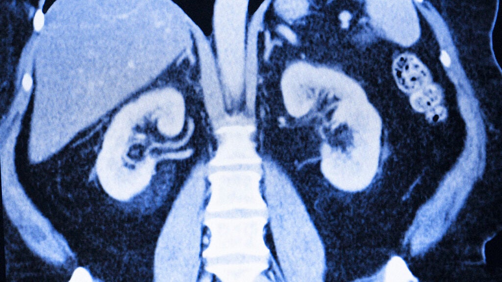 Types of kidney cancers Symptoms, treatment, and outlook