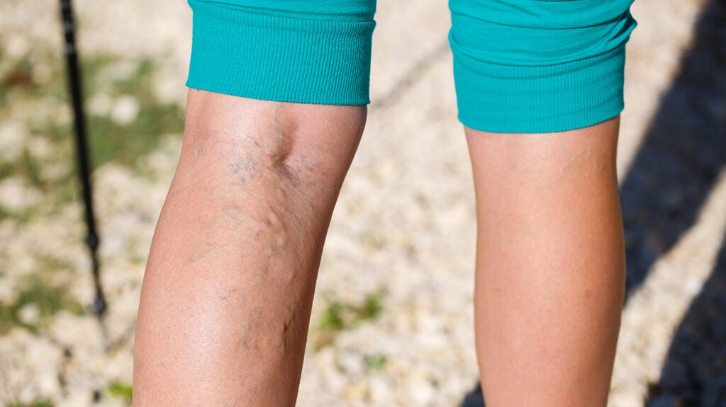 What Causes Varicose Veins in Legs? - Vein Center of Brinton Lake