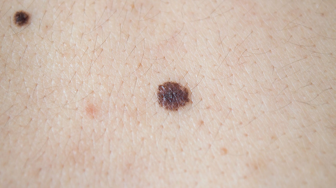 Metastatic Melanoma: Symptoms, Treatment, And Outlook