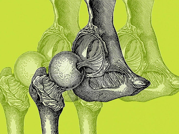 Femoral neck osteoporosis Causes, treatments, and more