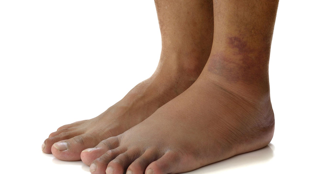 Swollen Legs And Ankles Causes And Their Treatments