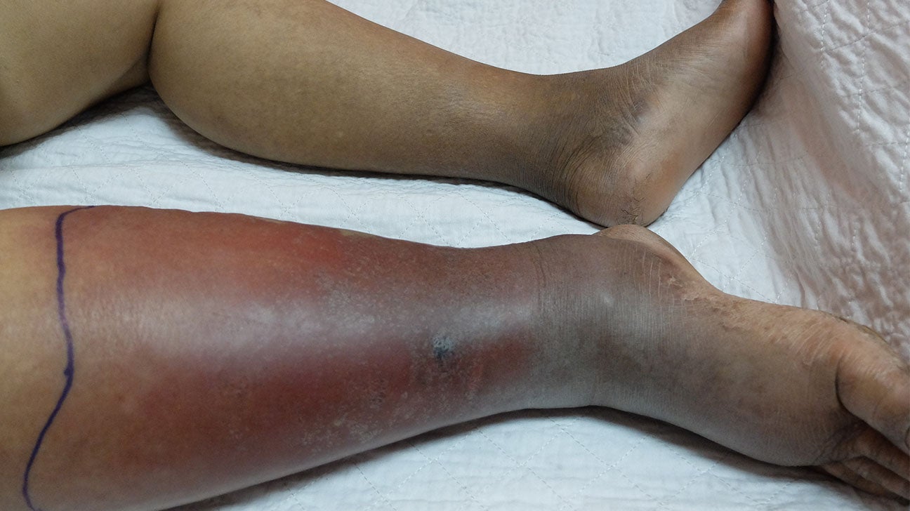 Swollen legs and ankles: Causes and their treatments