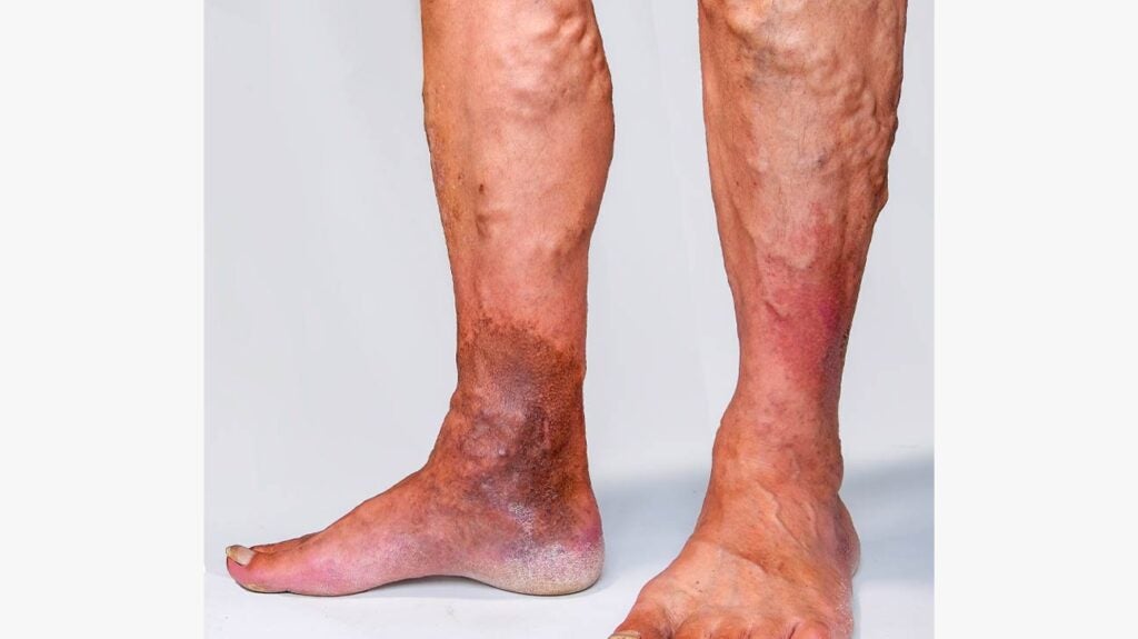 derularea picioarelor în varigalizare