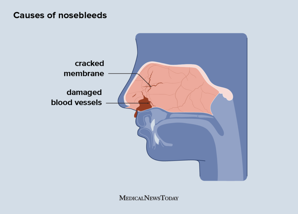 Why Do I Get Random Nosebleeds at Carrie Shumake blog