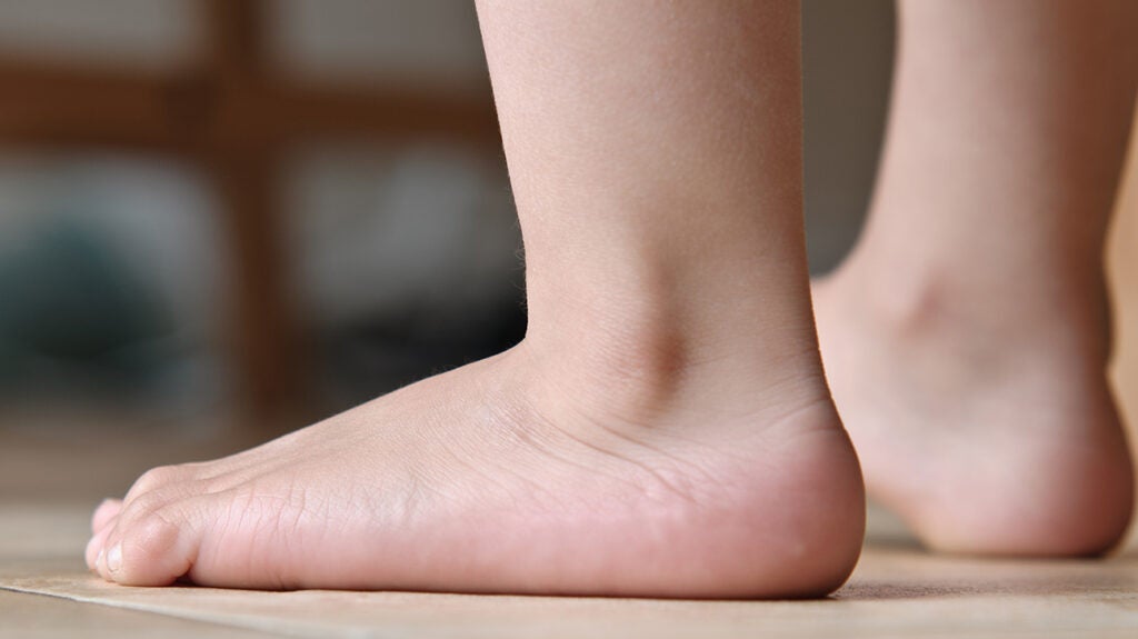 Meaning flat footed Flat feet
