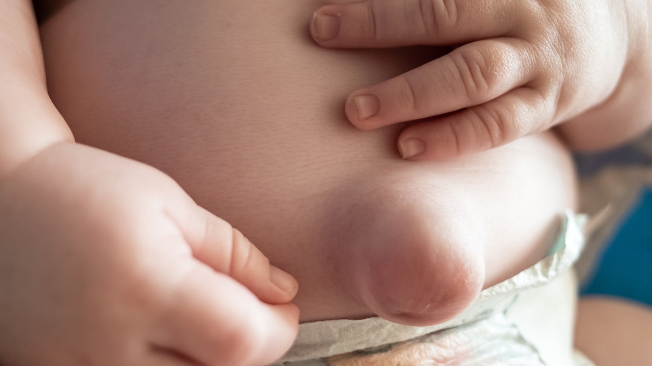 Umbilical hernia: Causes, symptoms, and treatments