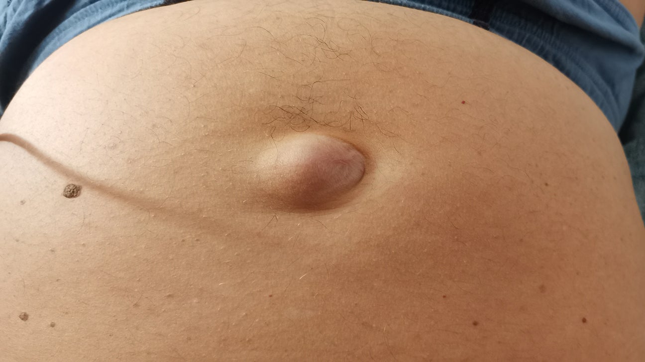 Umbilical Hernia (swollen belly button) - How to tell if you have one