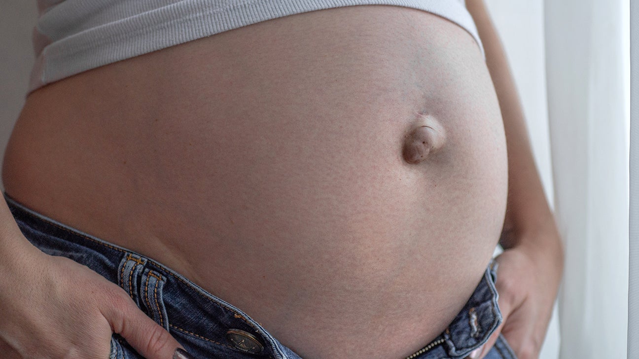 Signs and Symptoms of Umbilical Hernia