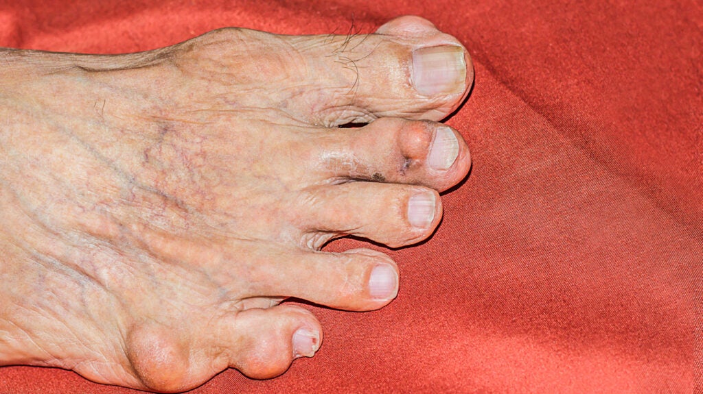 Rheumatoid nodules Symptoms, causes, and pictures