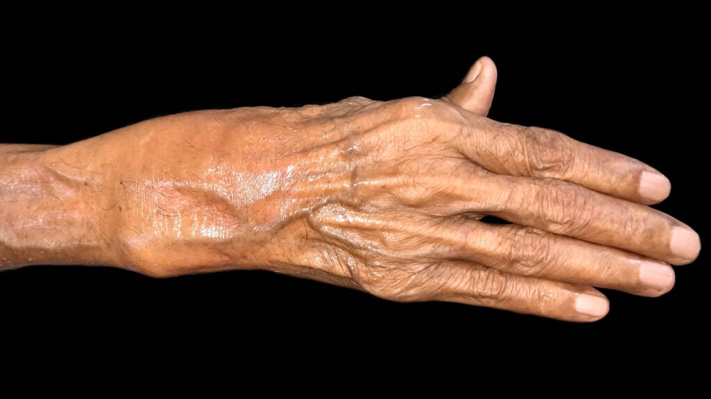 Rheumatoid nodules Symptoms, causes, and pictures