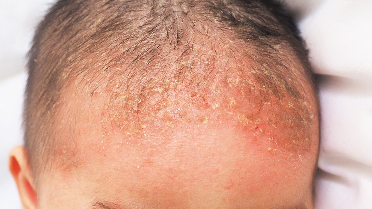 Scalp Psoriasis Pictures Treatment and More