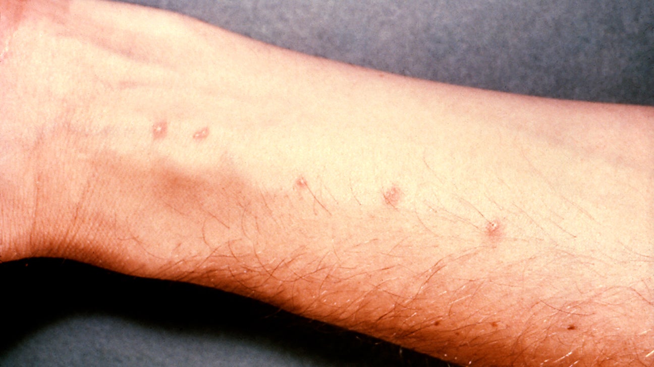 Spider Bites - American Osteopathic College of Dermatology (AOCD)