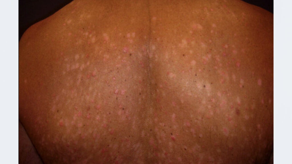 Guttate psoriasis Causes, symptoms, and treatment