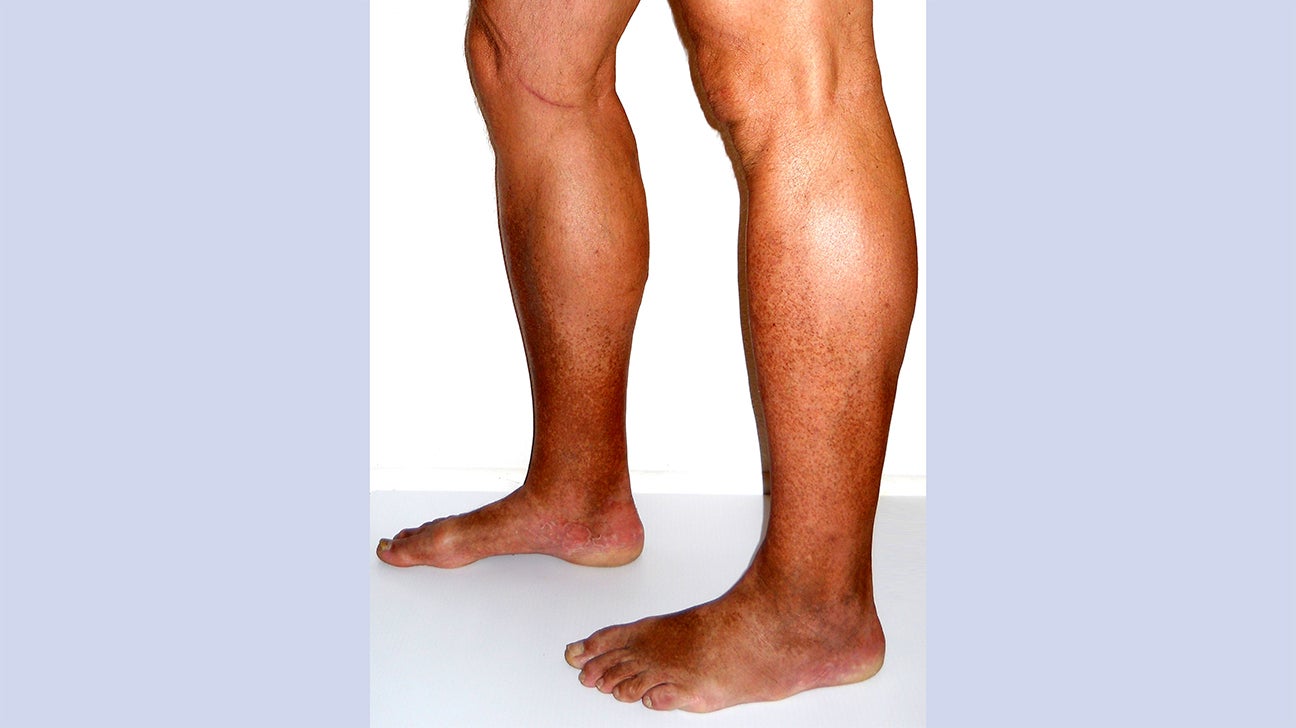 Medanta  How to Prevent Varicose Veins: Lifestyle Changes and Self-Care  Tips