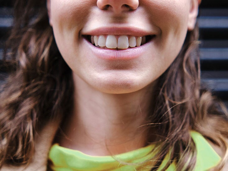 cavities between front teeth