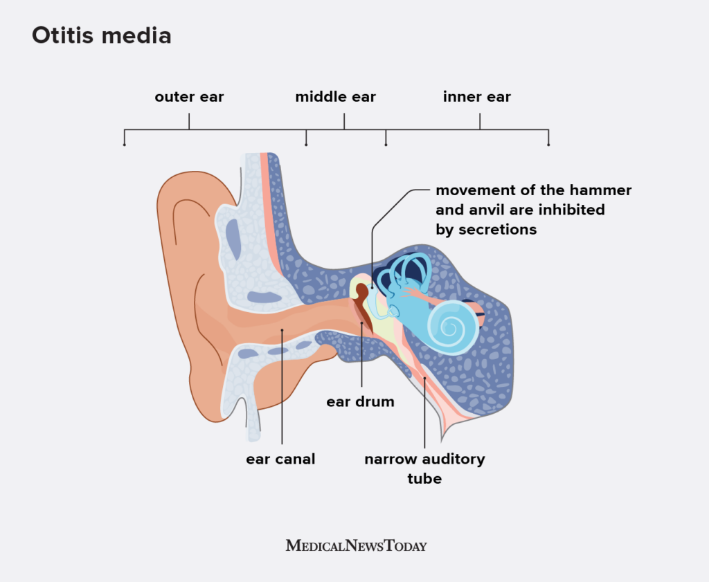 Acute Otitis Media Causes Pathophysiology Signs And S 2184