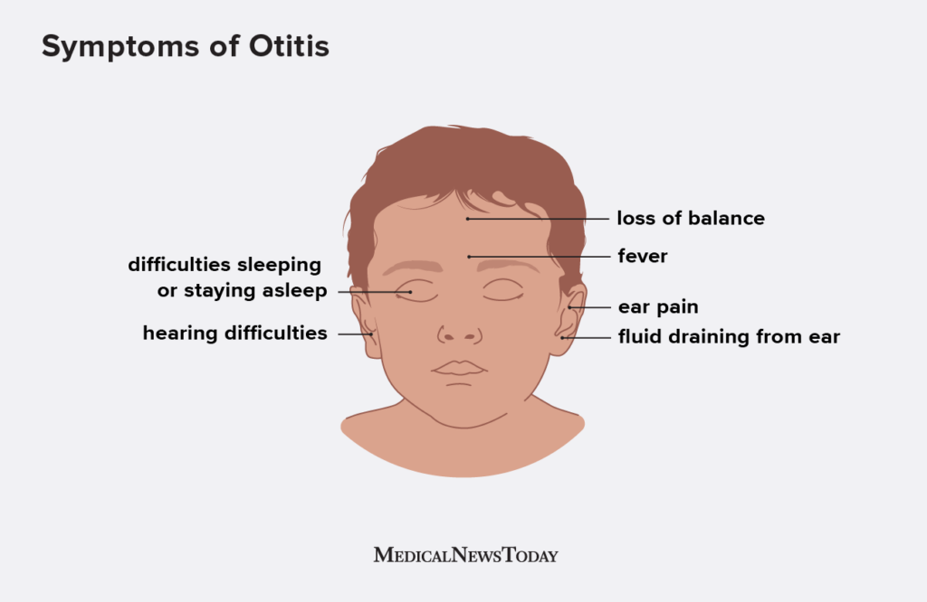 Otitis media: Symptoms and causes of middle ear infection