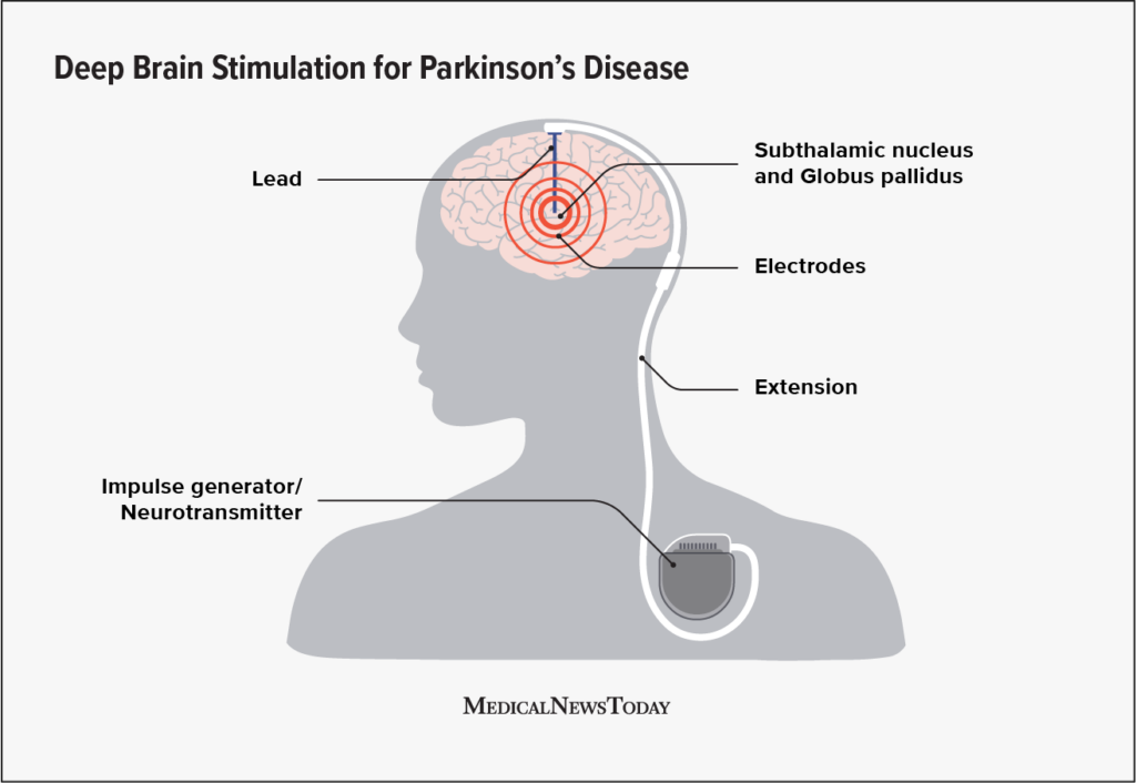 Deep Brain Stimulation Dbs For Parkinsons What To Expect