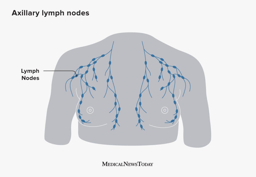 Axillary Lymph Nodes And Breast Cancer Are They Related 