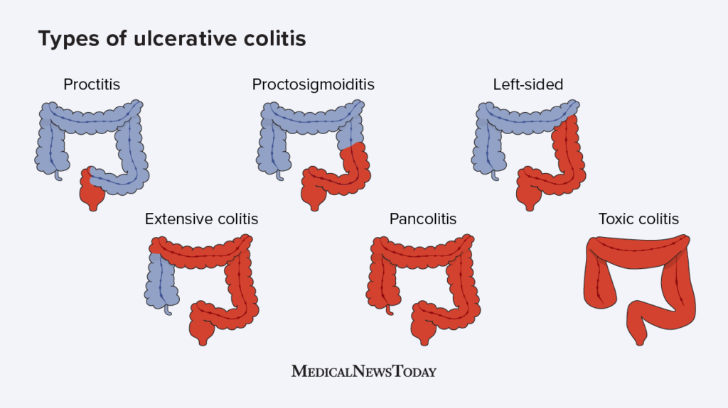 Ulcerative colitis: Types, treatments, and more