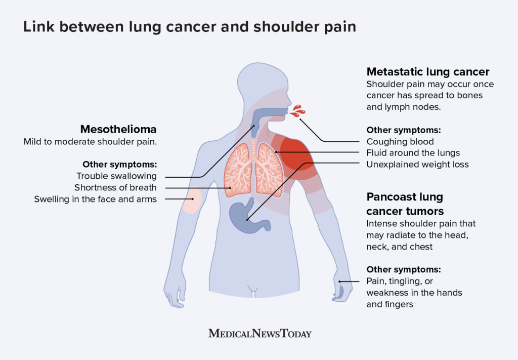 1868432 The Link Between Lung Cancer And Shoulder Pain 1296x900 Body 1024x711 