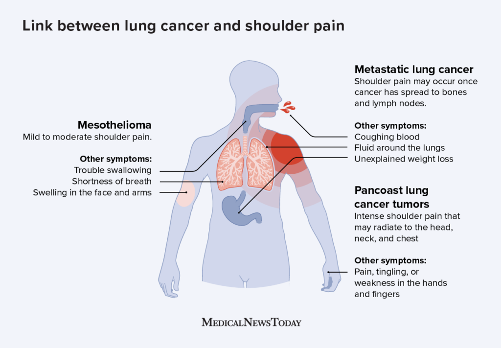 Early Signs Lung Cancer Shoulder Pain Early Signs And Symptoms Of Lung 