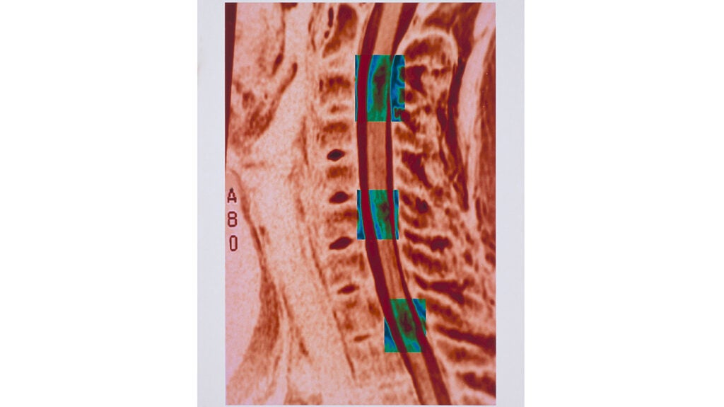 MS Brain Lesions and Their Effects