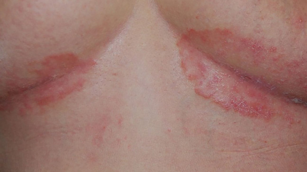 Inverse psoriasis: Causes, symptoms, and more