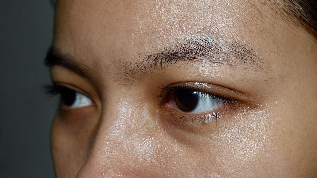 Oily eyelids Causes, treatment, and prevention