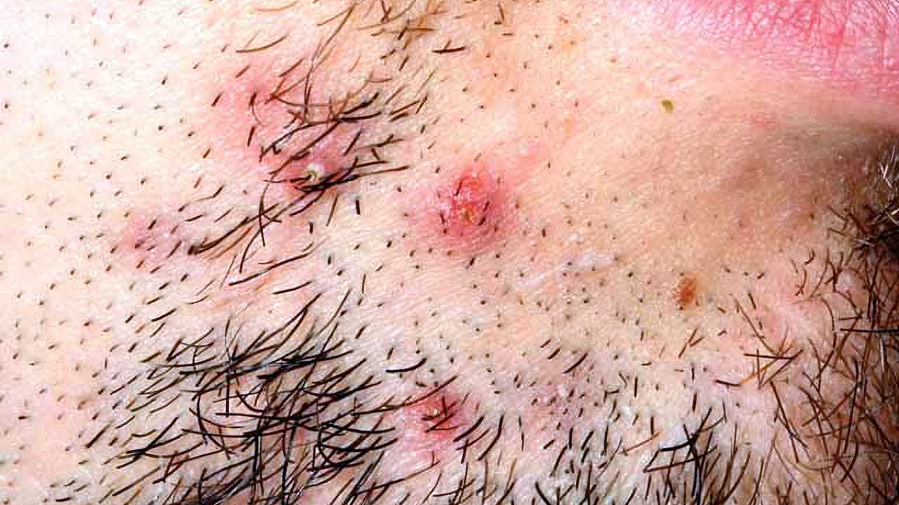 8 ways to treat razor bumps fast