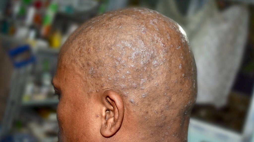 Pictures Of Sores And Scabs On Scalp: Causes And More