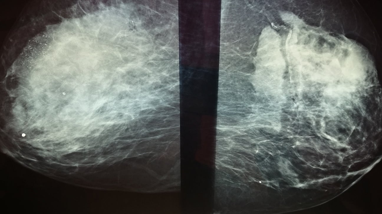 Breast Asymmetry and Calcification: Causes, Symptoms, Treatment