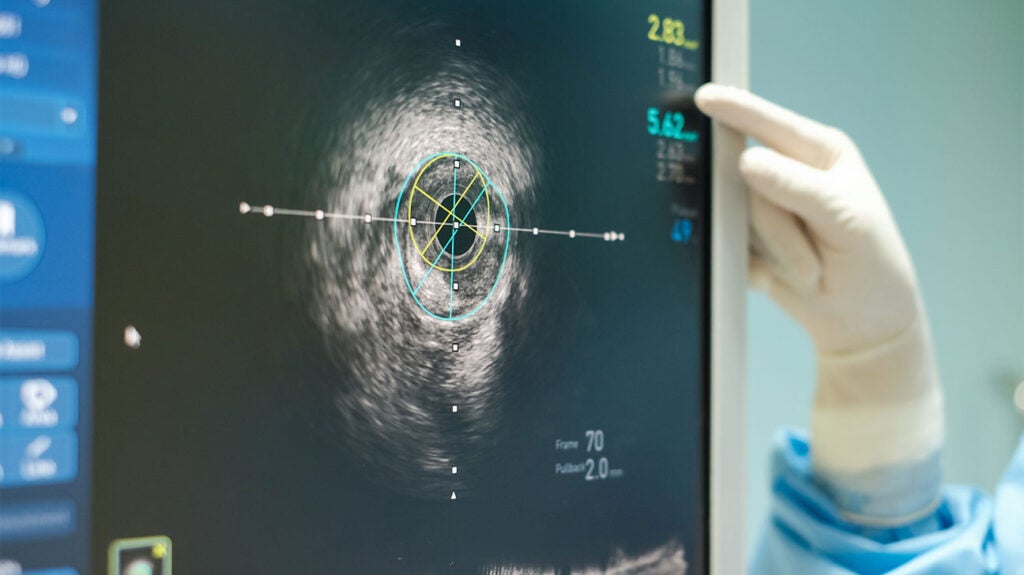 Everything to know about coronary calcium scans