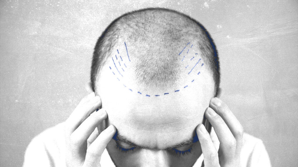 Infected hair plugs Symptoms, causes, risks, treatment