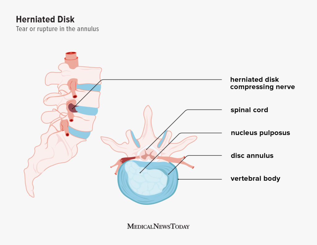 Herniated Disk Causes Symptoms Diagnosis And Treatment