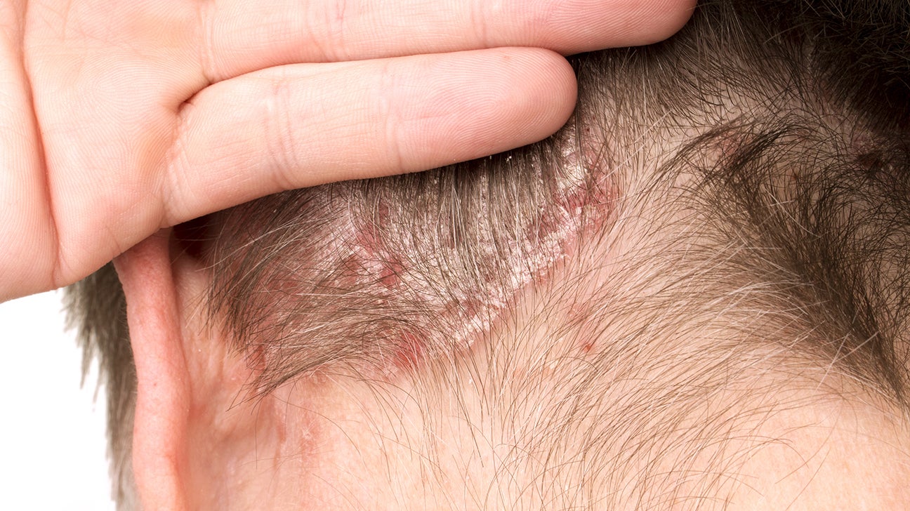 scalp scabs picking