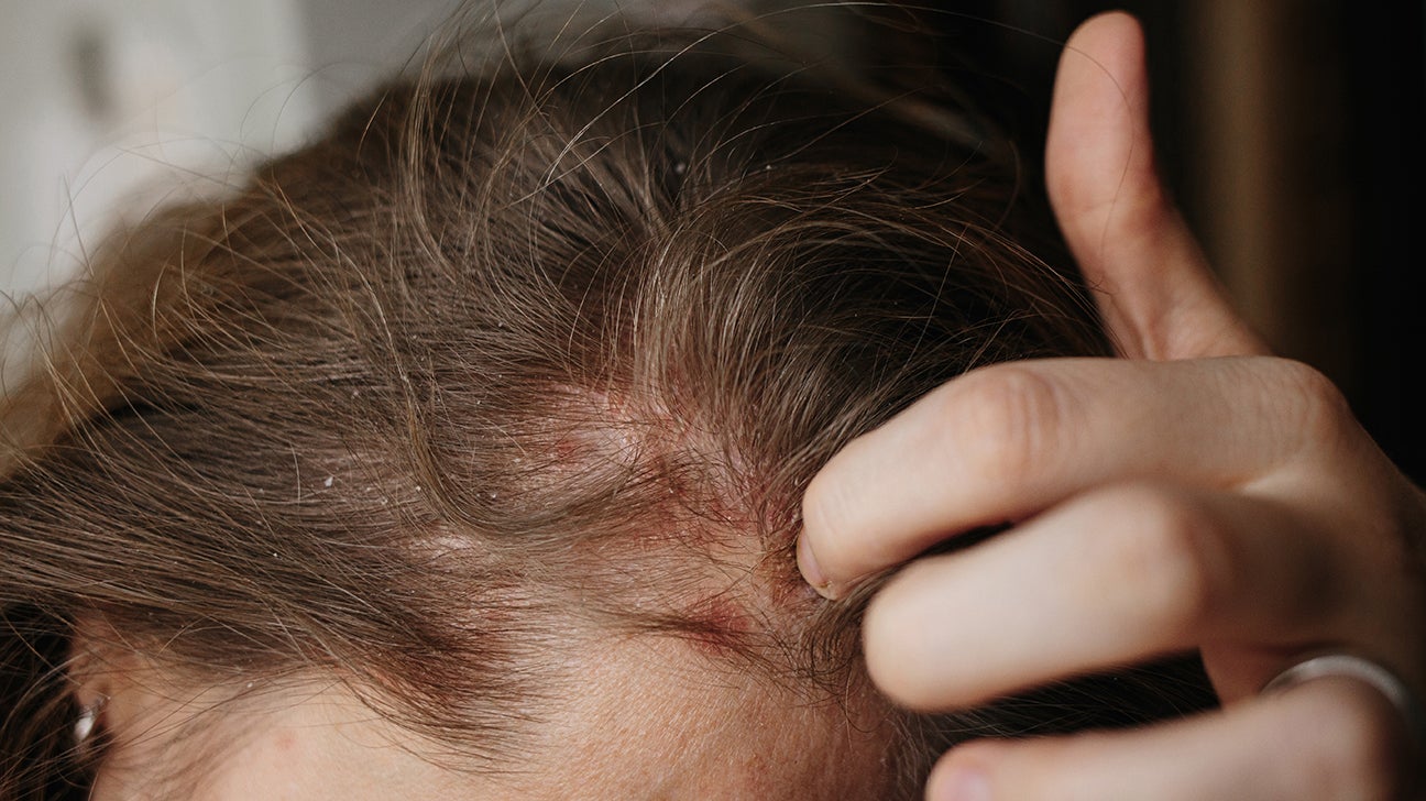 Scalp psoriasis: Symptoms, causes, and treatment