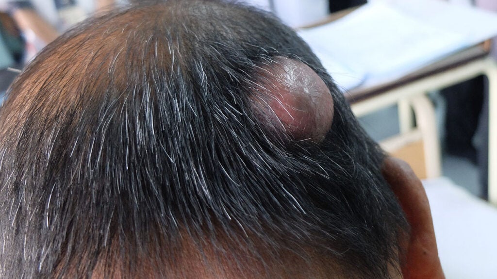 Update more than 77 head sores and hair loss latest