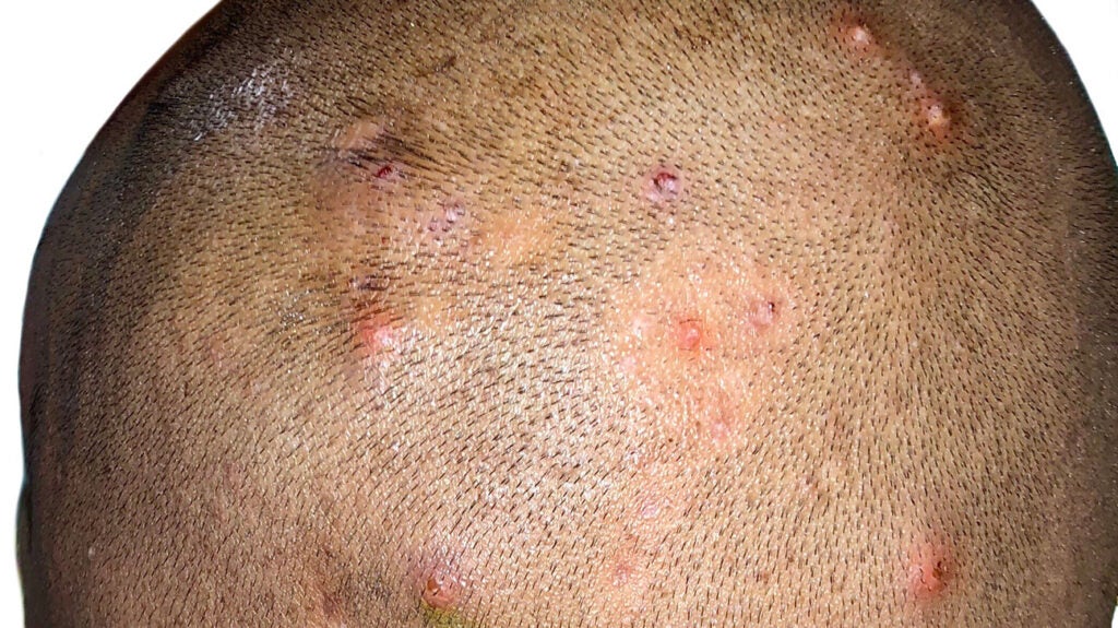 Pictures of sores and scabs on scalp: Causes and more