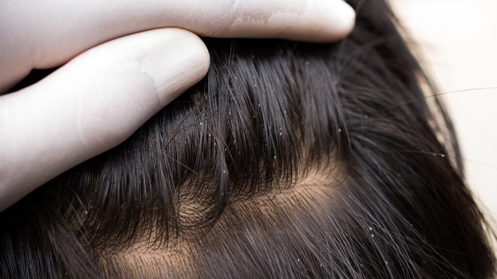 Sores and scabs on scalp: Causes, treatment, and prevention
