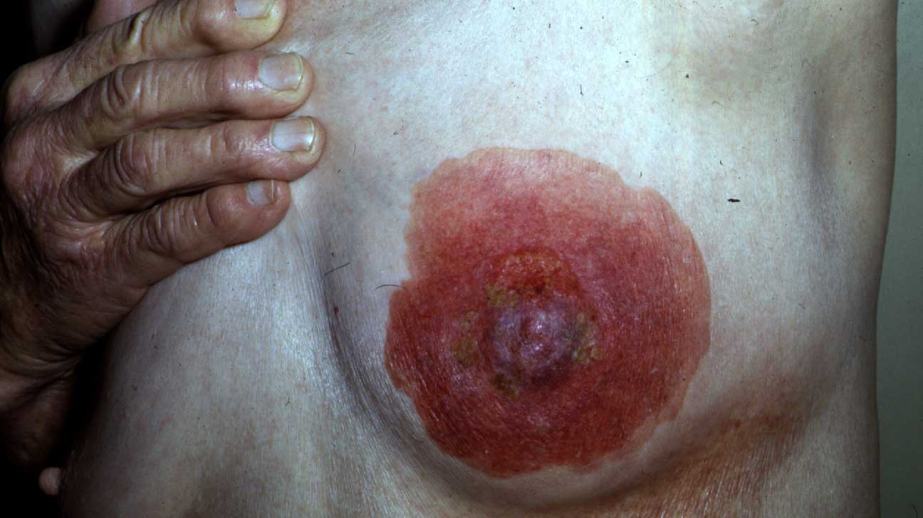 Paget's disease of the breast: Causes, symptoms, treatment, and more