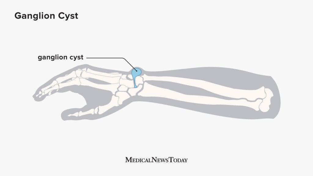 Ganglion cyst: Symptoms, causes, and treatment