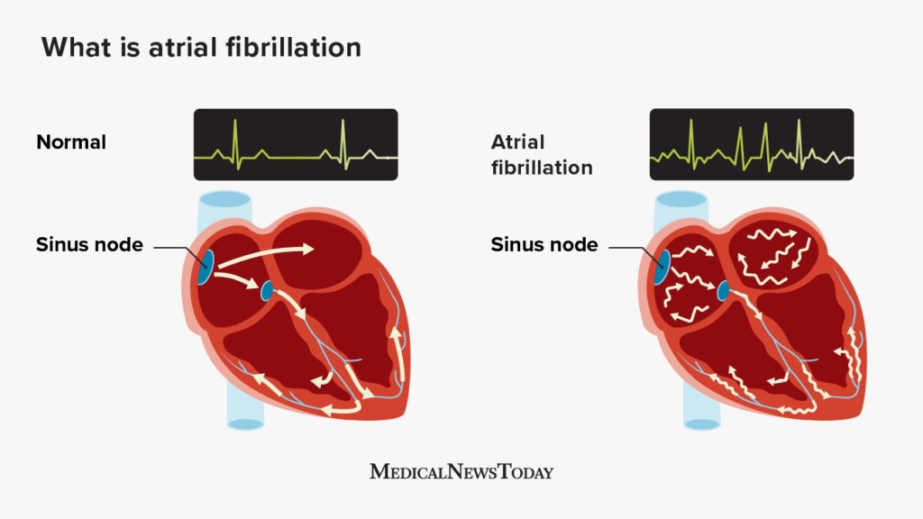 Atrial Fibrillation: Symptoms, Causes, Treatment, And More